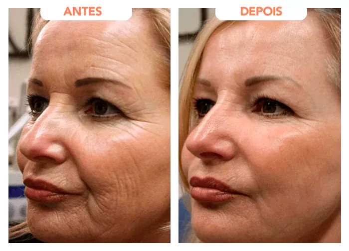 Depoimento de Frasncisca, 53 anos